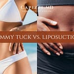 Tummy Tuck vs. Liposuction What's the Difference? Comparison image between both procedures.